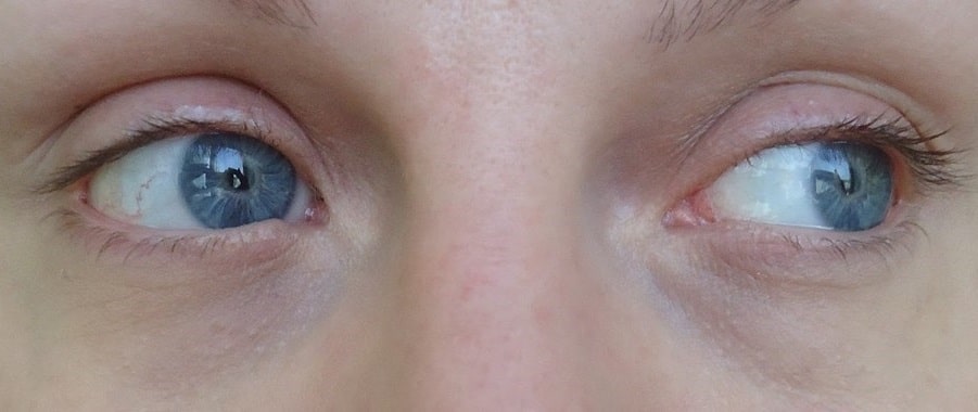 Des cernes sur un visage féminin