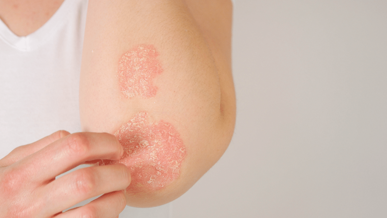 psoriasis : image montrant des plaques rouges et squameuses sur la peau