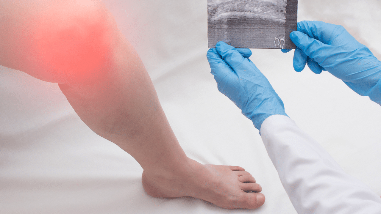 gonarthrose : représentation du genou avec dégradation du cartilage