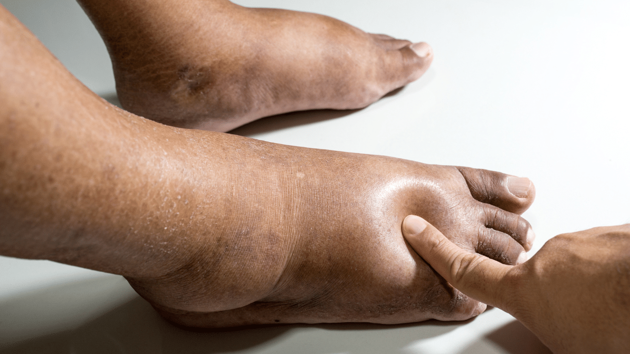 diabète : illustration des pieds affectés par des complications diabétiques